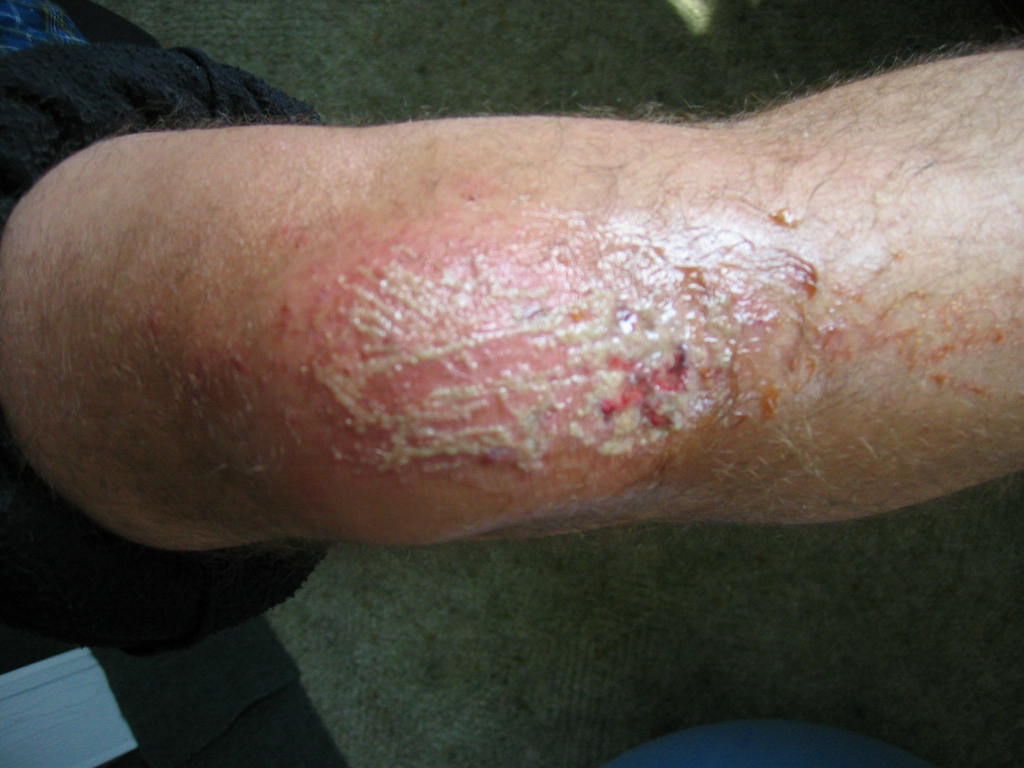 right knee with slight flesh wound.JPG